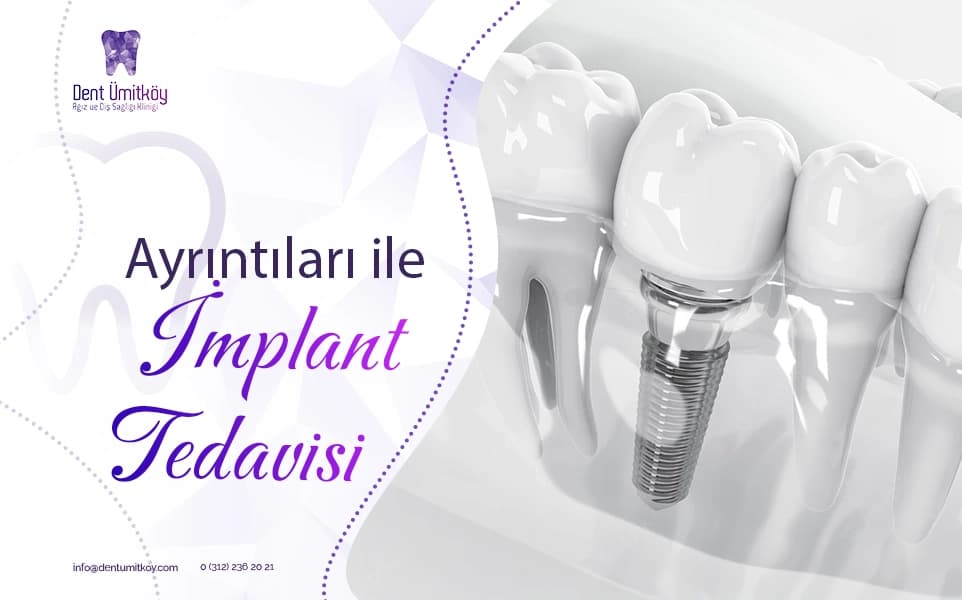 Diş İmplantları