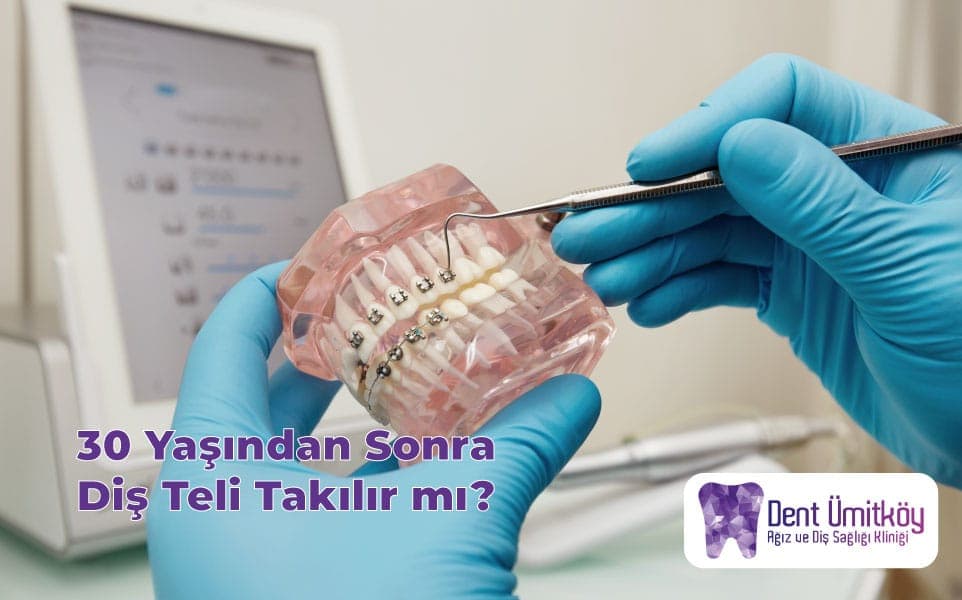 30 Yaşından Sonra Diş Teli Takılır mı? Yetişkin Ortodontisi Hakkında Her Şey