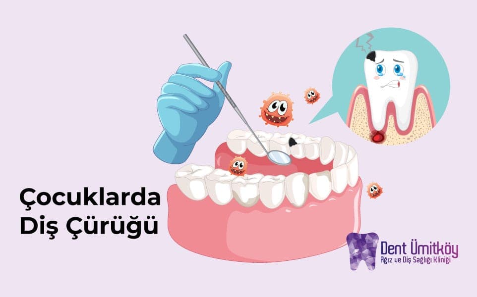Ankara Çocuklarda Diş Çürüğü Tedavisi: Sağlıklı Gülüşler İçin Ebeveyn Rehberi