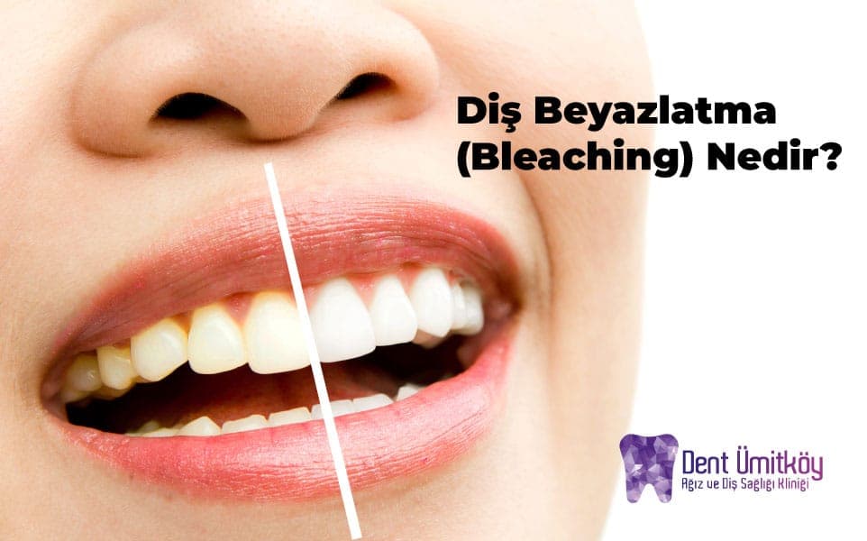 Ankara Diş Beyazlatma (Bleaching) Nedir?