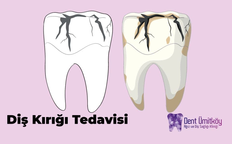 Ankara Diş Kırığı Tedavisi: Gülüşünüzü Yeniden İnşa Etme Rehberi