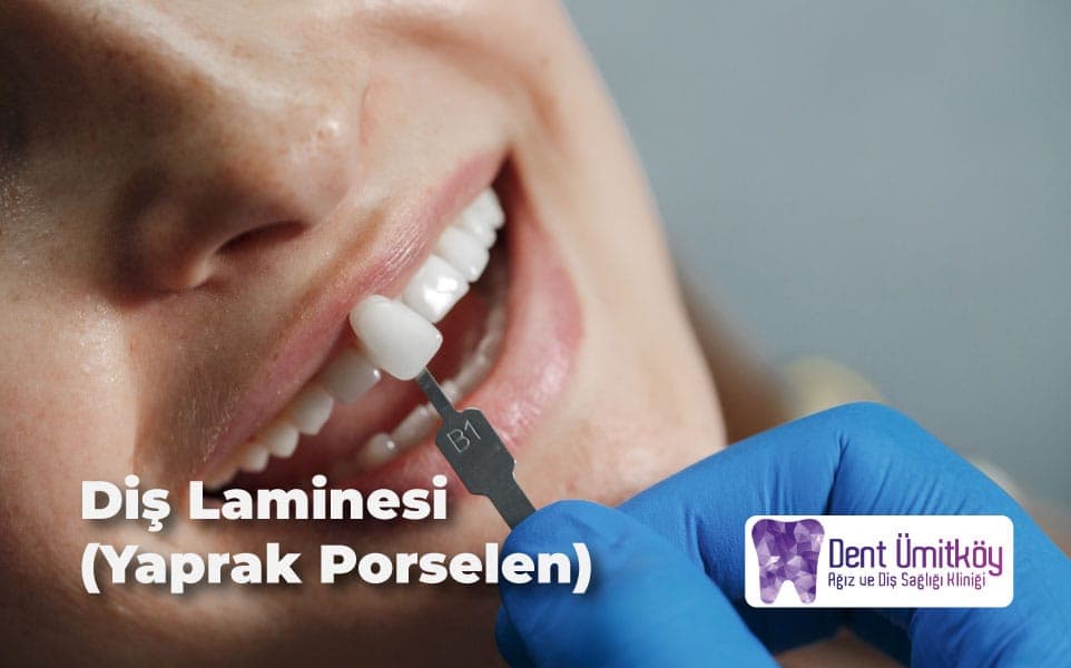 Guide to Dental Veneers (Porcelain Laminates) in Ankara
