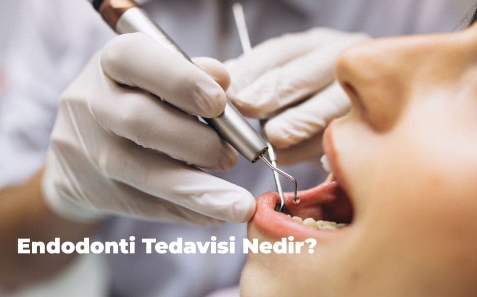 Endodontic Treatment in Ankara: What You Need to Know to Save Your Tooth