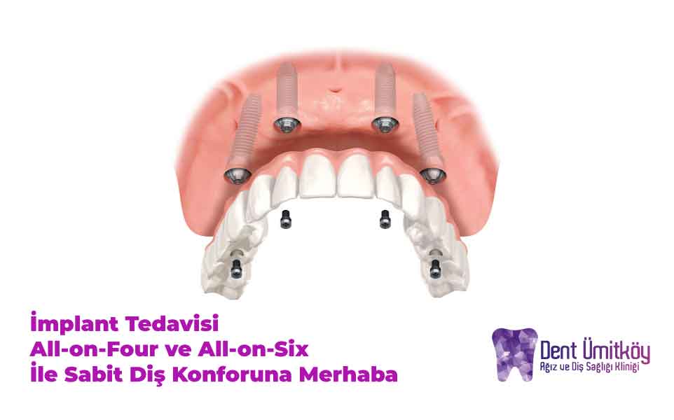 Ankara İmplant Tedavisi ile Sabit Diş Konforuna Merhaba