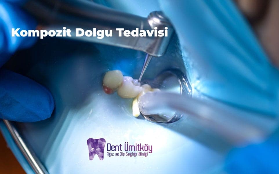 Ankara Kompozit Dolgu Tedavisi