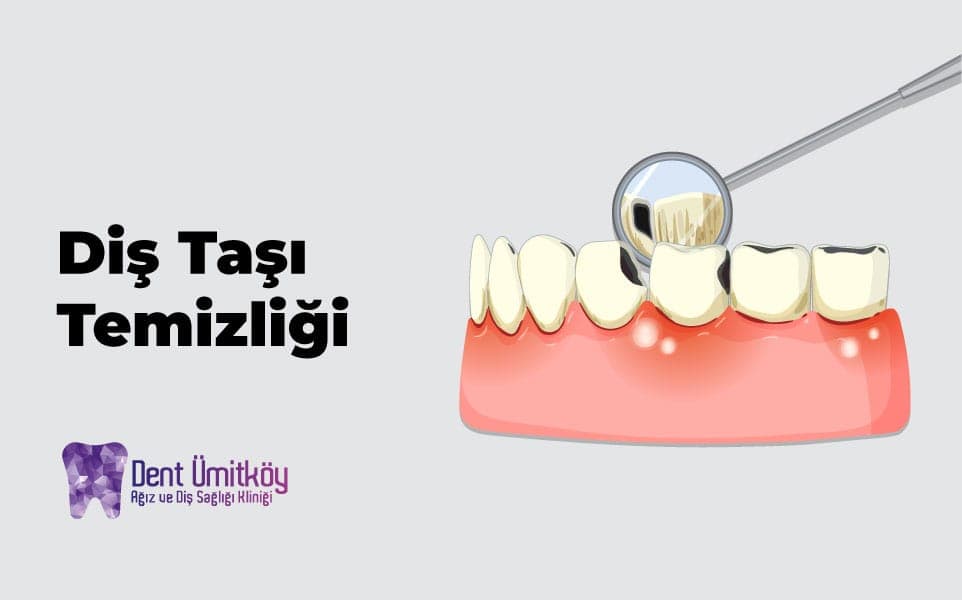 Çayyolu Diş Taşı Temizliği: Detertraj Nedir ve Neden Hayatidir?