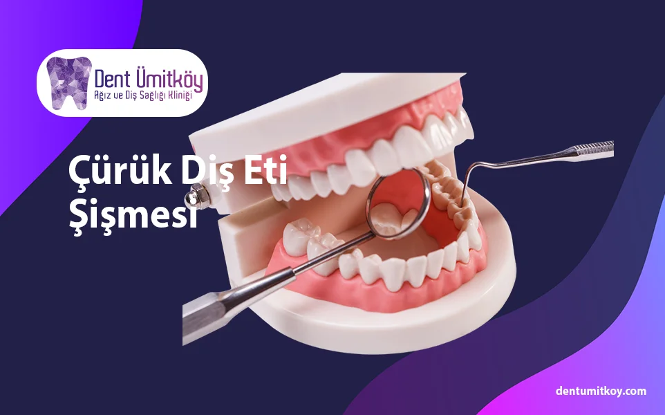 Gum Swelling from Tooth Decay