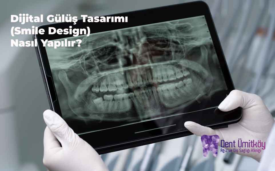 Dijital Gülüş Tasarımı (Smile Design) Nasıl Yapılır?
