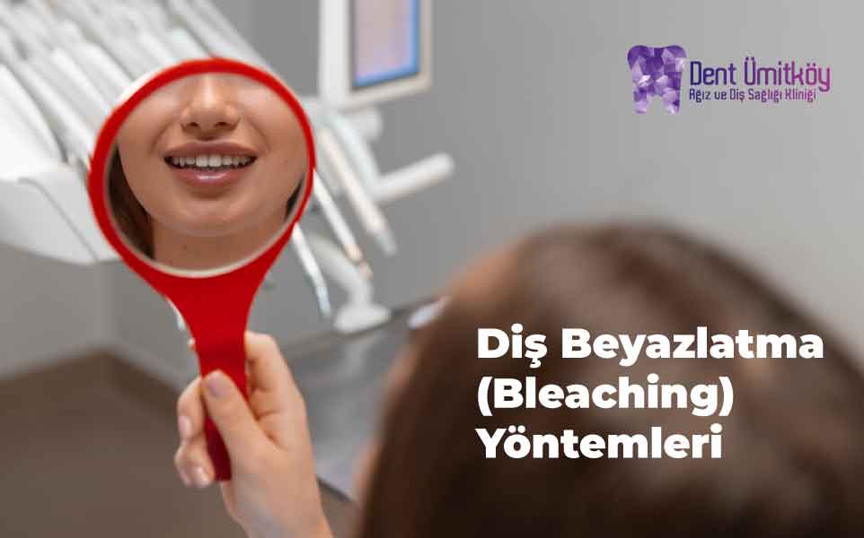 Diş Beyazlatma (Bleaching) Yöntemleri: Işıltılı Bir Gülüşün Sırrı