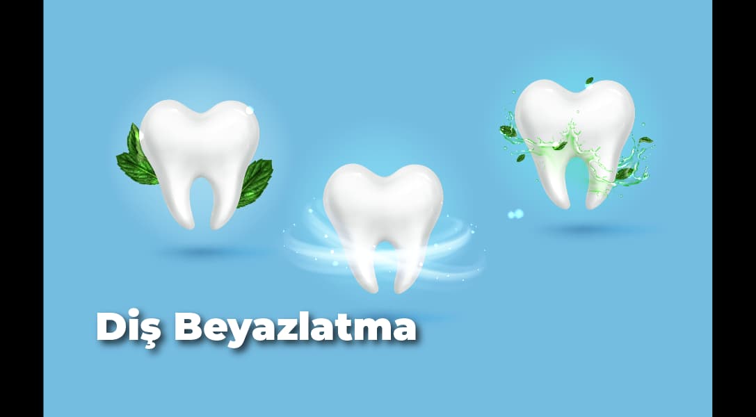 Factors Behind Teeth Whitening Prices in Ankara