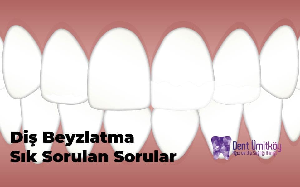 Diş Beyazlatma Hakkında Sıkça Sorulan Sorular