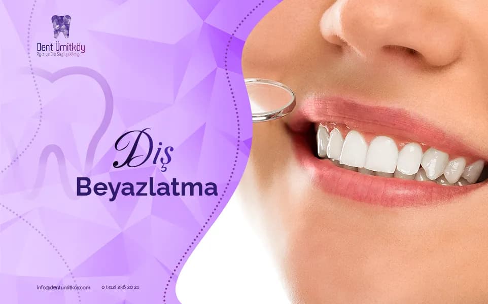 Diş Beyazlatma