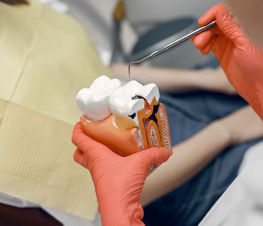 Dental Fillings: An Effective Solution for Decayed and Chipped Teeth