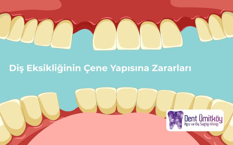 Diş Eksikliğinin Çene Yapısına Zararları: Sessizce İlerleyen Tehlike
