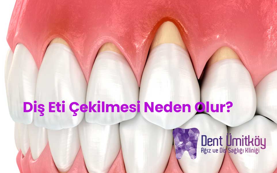 Diş Eti Çekilmesi Neden Olur?