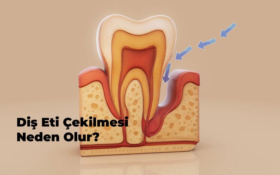 Diş Eti Çekilmesi Neden Olur? Belirtileri ve Tedavi Yöntemleri