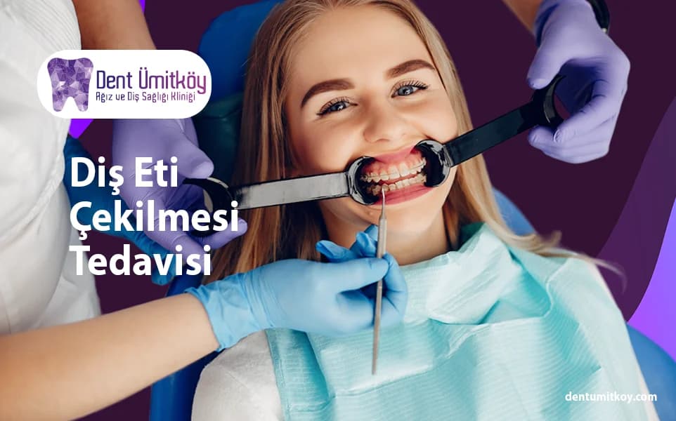 Treatment for Gum Recession