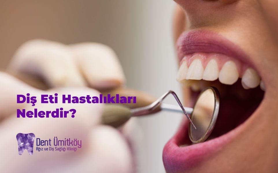 Diş Eti Hastalıkları Nelerdir? Belirtileri, Aşamaları ve Tedavisi