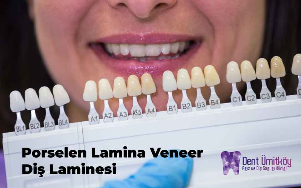 Diş Laminesi, Porselen Lamina Veneer Ankara
