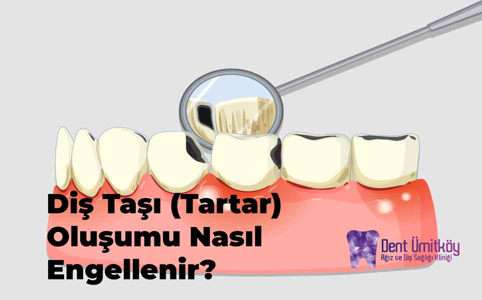 Diş Taşı (Tartar) Oluşumu Nasıl Engellenir? 5 Adımda Kesin Çözüm