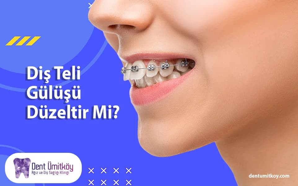 Do Braces Improve Your Smile?