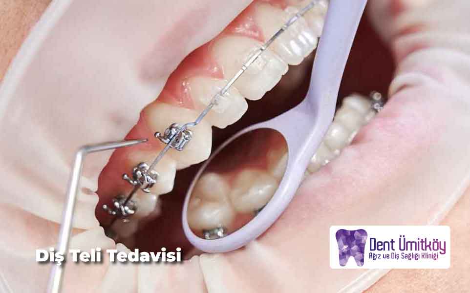 Braces Treatment