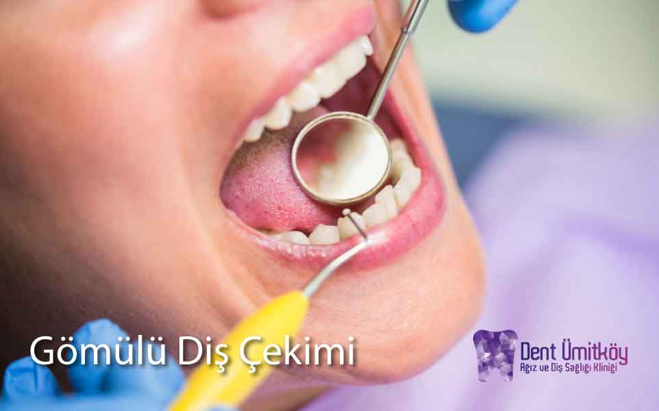 Impacted Tooth Extraction in Ankara