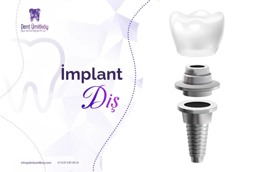 Dental Implants