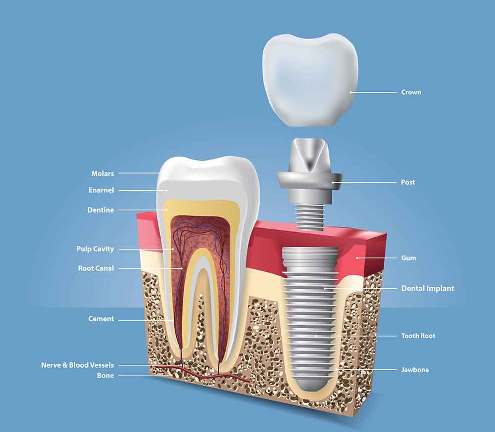 Implants: A Permanent, Aesthetic Solution for Missing Teeth
