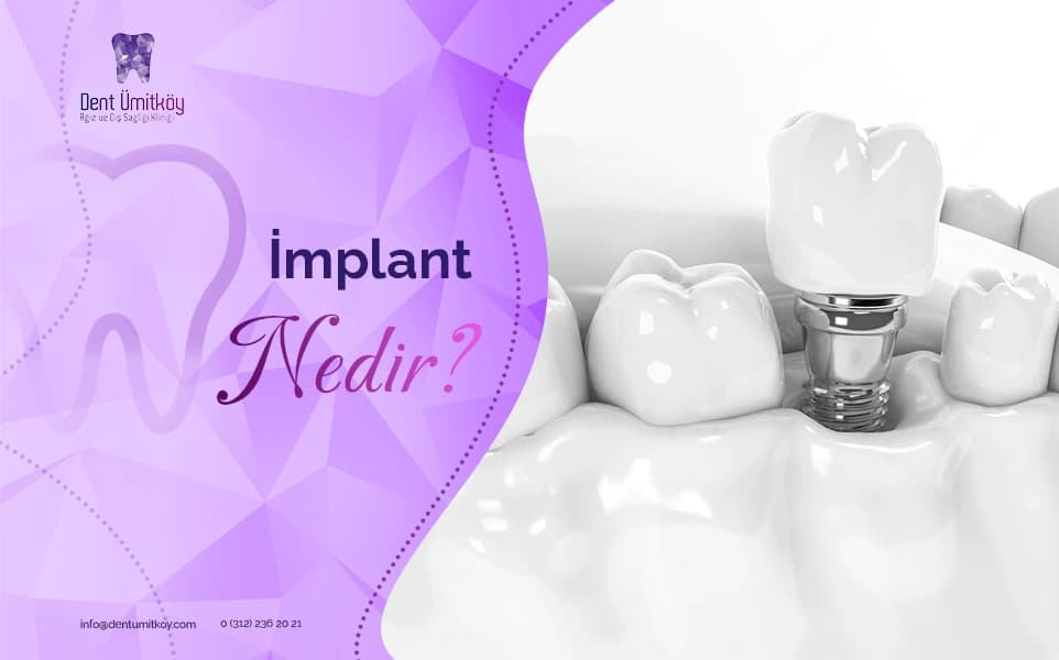 What Is a Dental Implant?