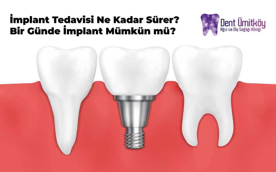 İmplant Tedavisi Ne Kadar Sürer? Bir Günde İmplant Mümkün mü?