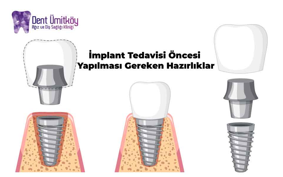 Preparations Before Implant Treatment: A Step-by-Step Guide