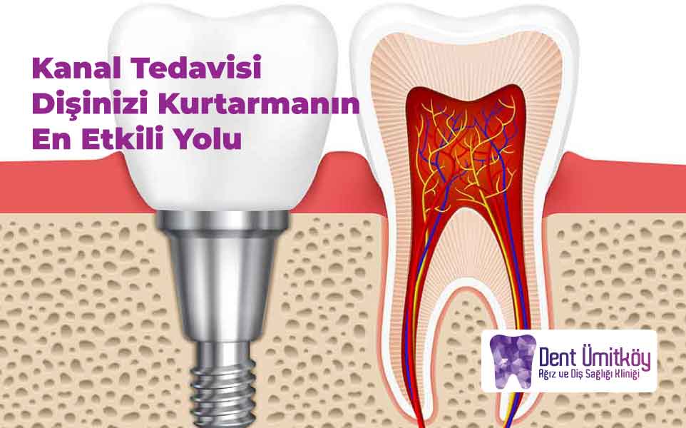 Kanal Tedavisi: Dişinizi Kurtarmanın En Etkili Yolu