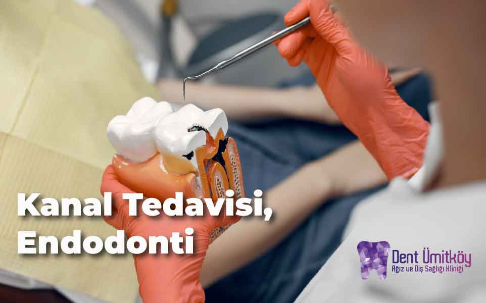 Kanal Tedavisi (Endodonti) Ankara: Dişinizi Kaybetmekten Korkmayın