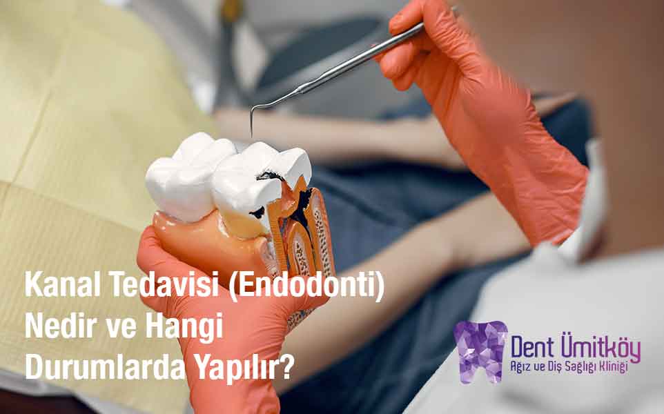Kanal Tedavisi (Endodonti) Nedir ve Hangi Durumlarda Yapılır?