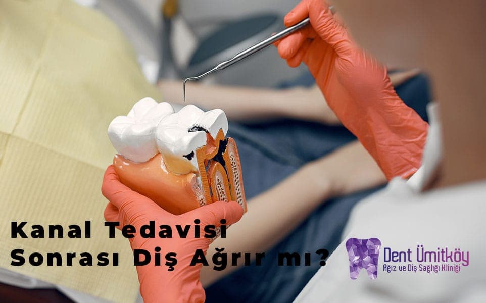 Kanal Tedavisi Sonrası Diş Ağrır mı? Bilmeniz Gereken Tüm Detaylar
