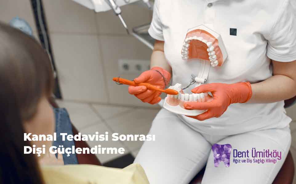 Kanal Tedavisi Sonrası Dişi Güçlendirme: Fiber Post ve Core
