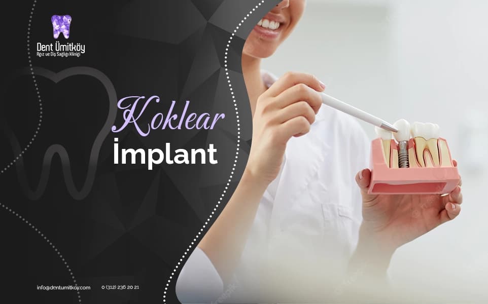 Cochlear Implants