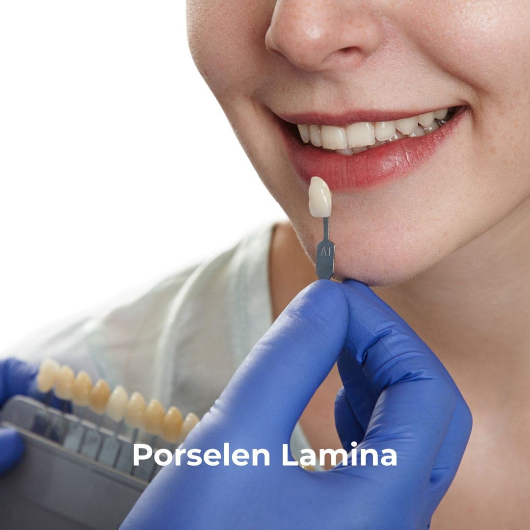 Porselen Lamina Estetik Gülüş İçin Modern Çözüm