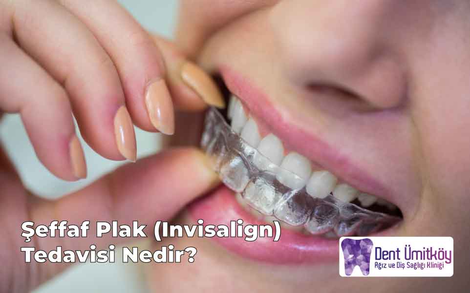 Şeffaf Plak (Invisalign) Tedavisi Nedir?
