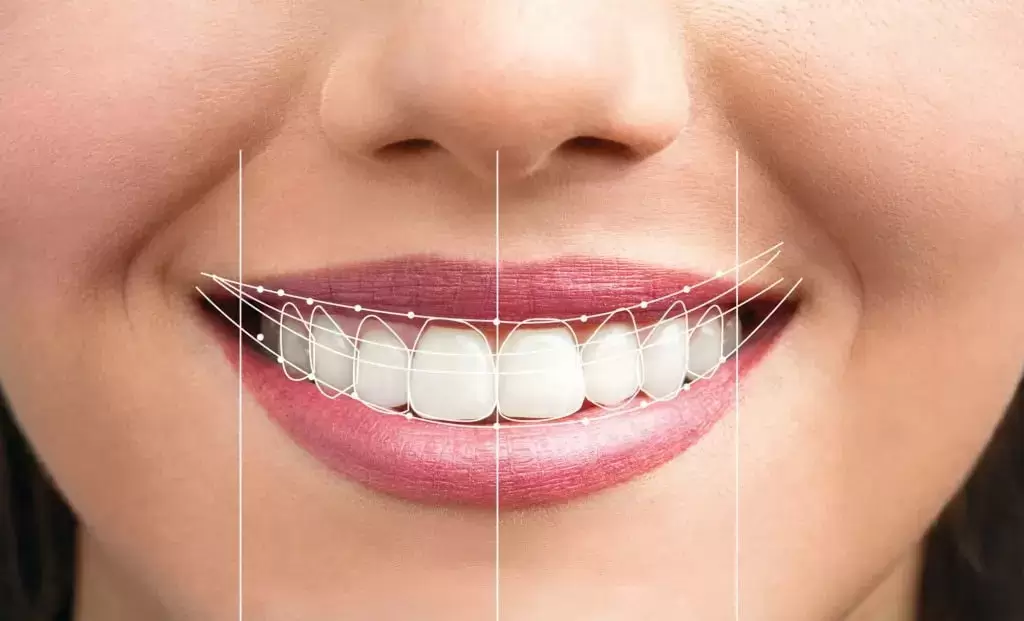 Make a Difference in Your Smile with a Smile Makeover
