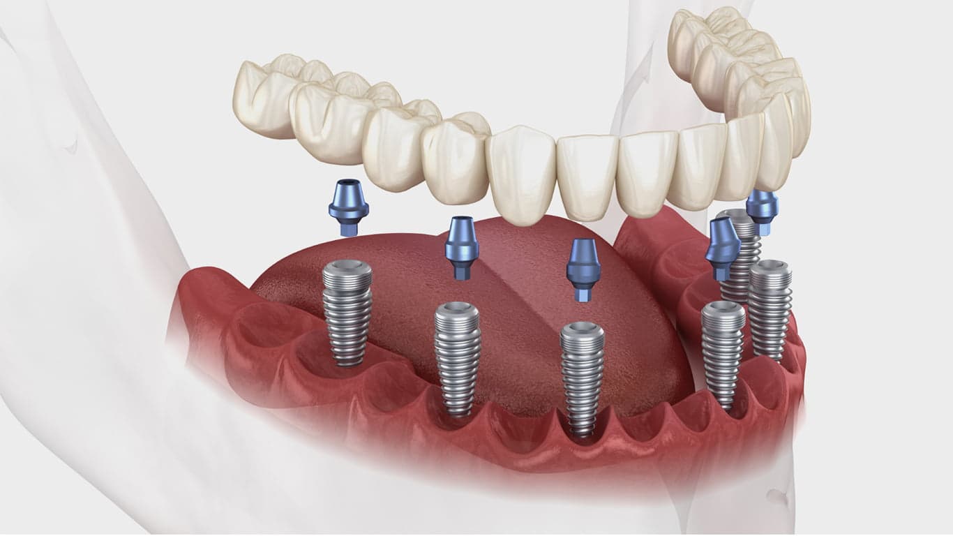 All-on-8 Dental Implants in Turkey