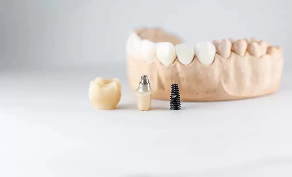 Implant Treatment with Details
