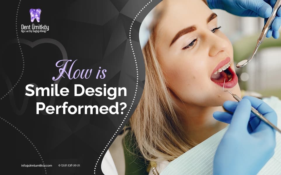 How is Smile Design Performed?