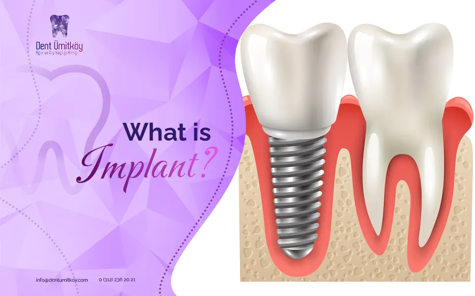 What is Implant?