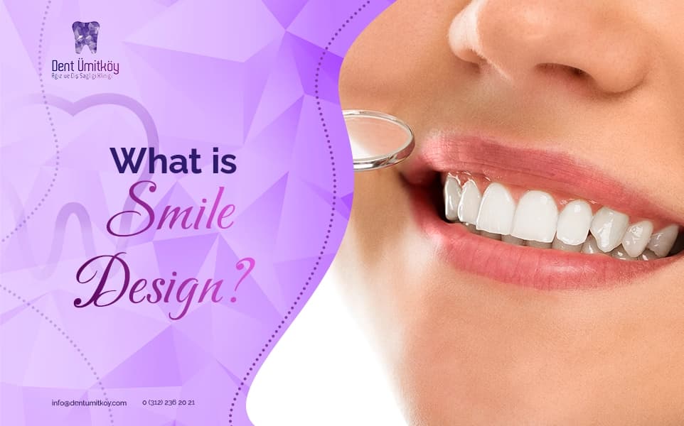 What is Smile Design?