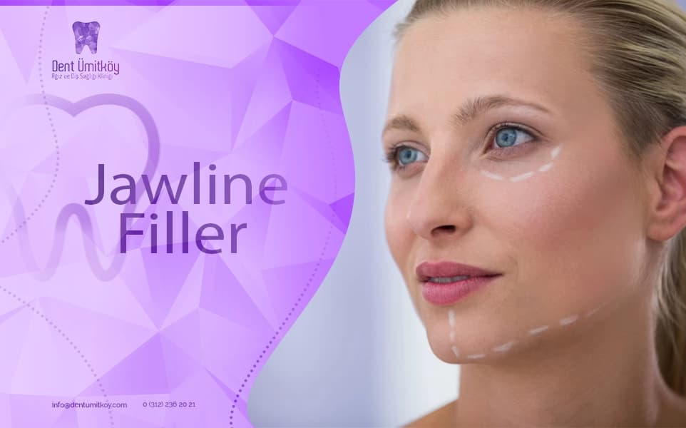 Jawline Filler