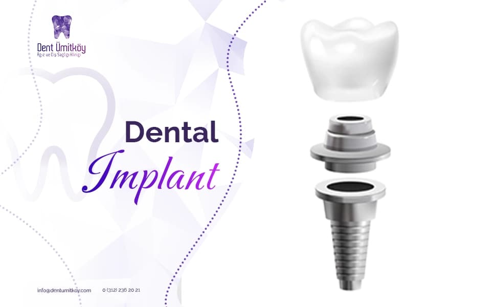 Dental Implant