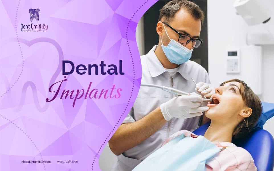 Dental Implants
