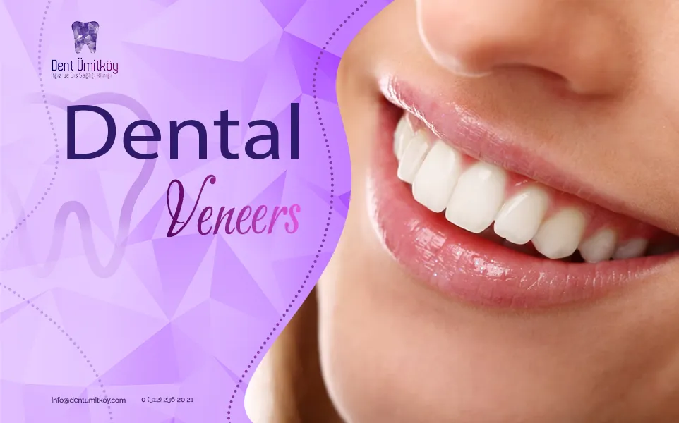 Dental Veneers